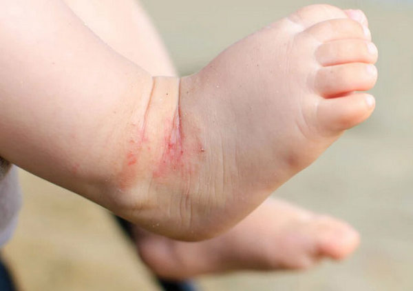 湿疹发生位置脚踝