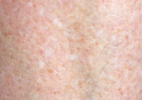 皮肤白斑特发性点状黑色素减少症皮肤病图片