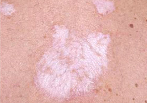 皮肤白斑硬化性苔藓皮肤病图片