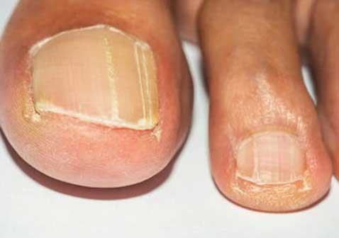 早期的灰指甲症状图片易碎边缘齿状