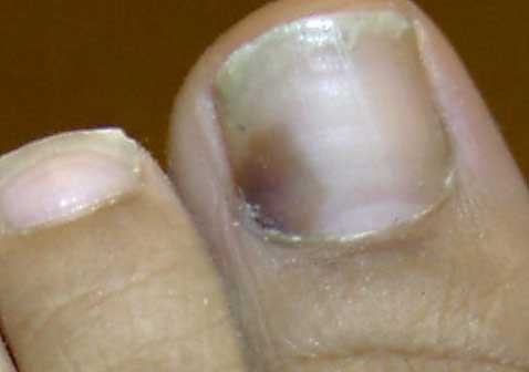 早期的灰指甲症状图片变黑