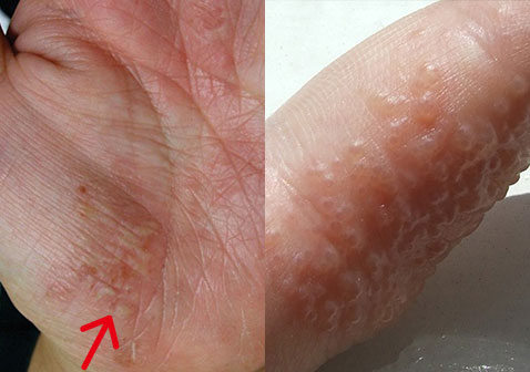 掌跖脓疱病和汗疱疹区别对比图片