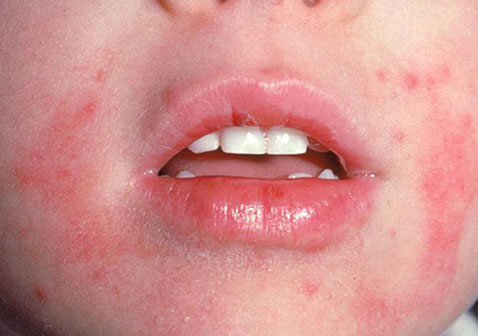 婴儿皮炎湿疹症状图片