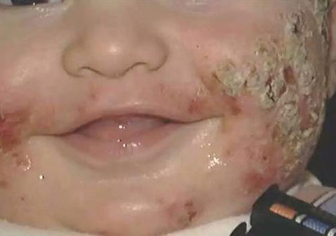 脸上婴儿皮炎湿疹症状图片