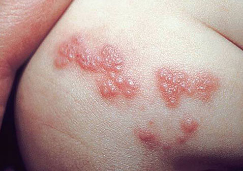 皮疹荨麻疹高清图片和症状