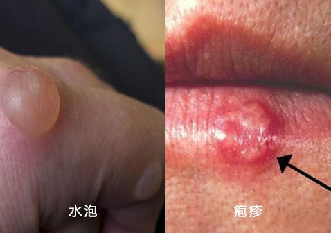 水泡和疱疹的区别对比图片