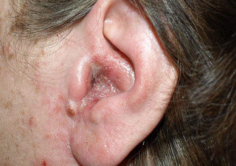 耳朵脂溢性皮炎图片
