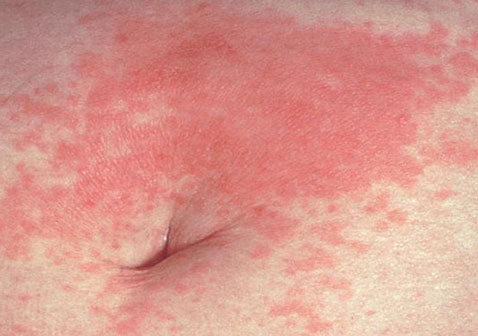初期红皮型银屑病图片症状红色皮疹
