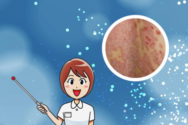 湿疹是什么原因造成的

