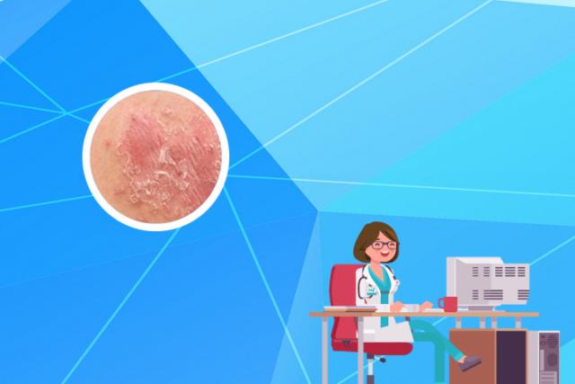 皮肤癣和湿疹怎么区分