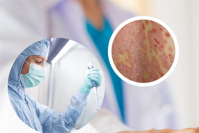 湿疹的皮肤病图片用什么药
