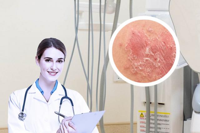 真菌感染皮肤病治疗
