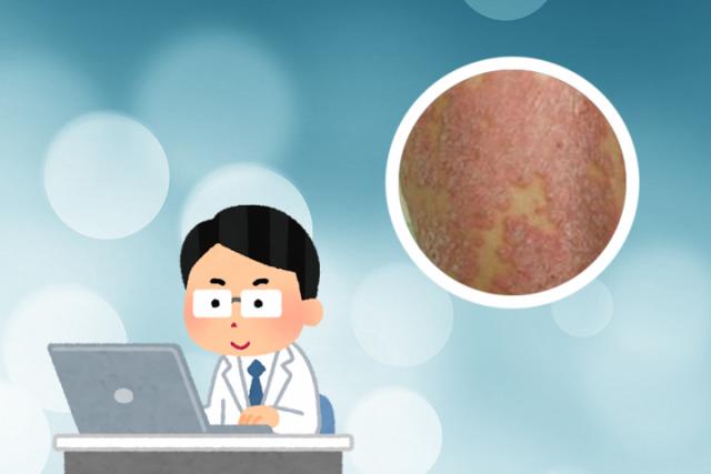 湿疹癣用什么药膏
