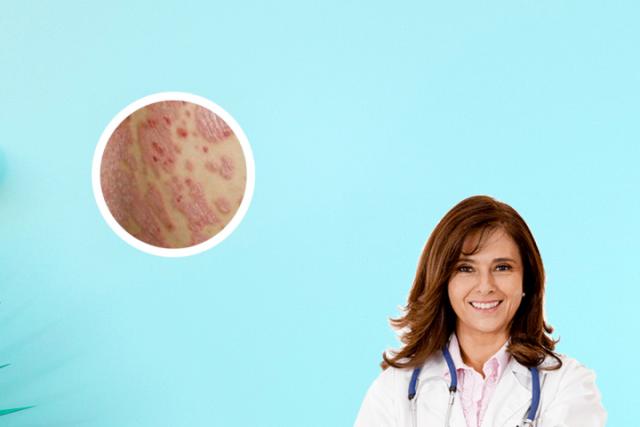 湿疹与银屑病区别图片